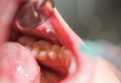 How Kuala Lumpur's Dental Clinics Are Raising Oral Cancer Awareness